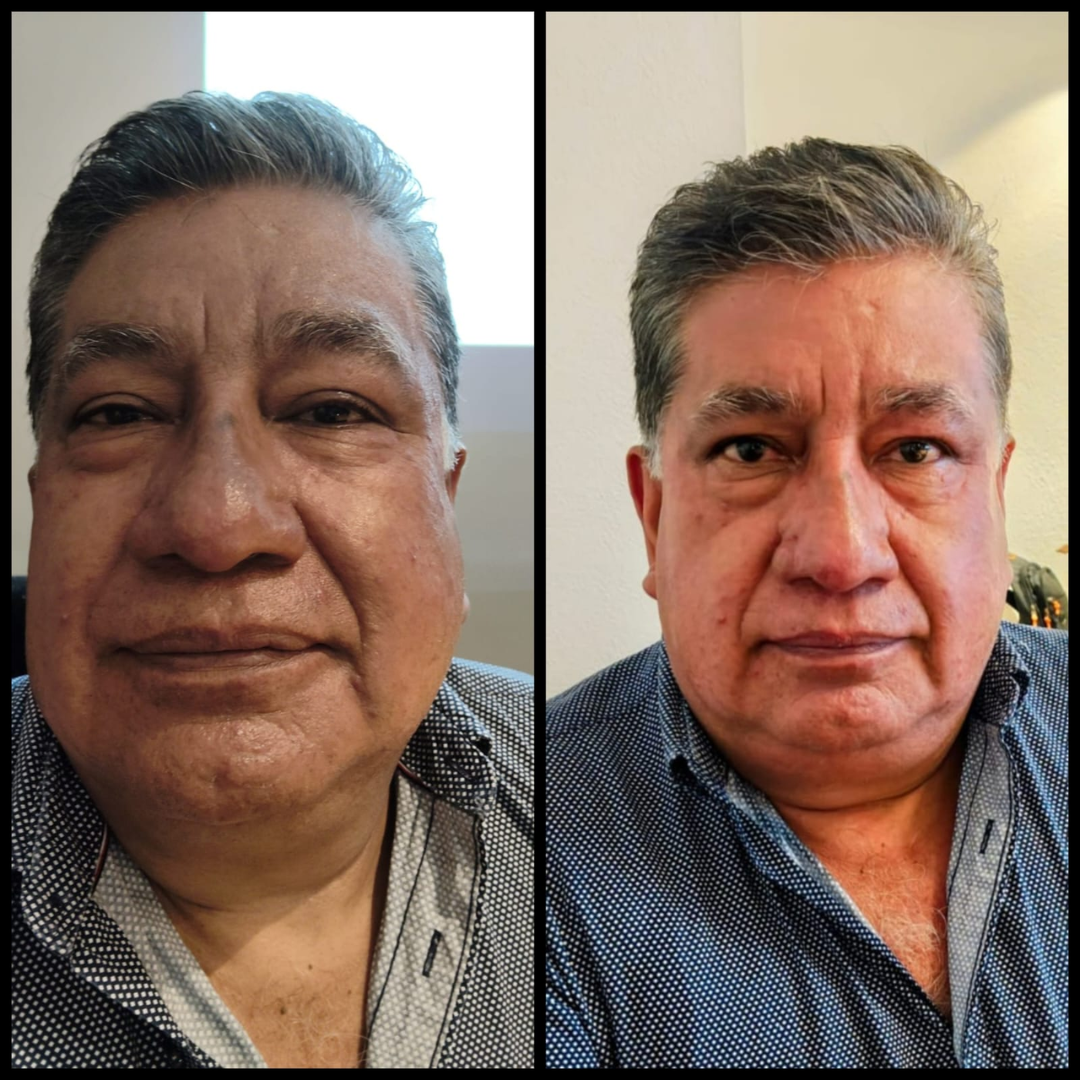 Testimonio real — piel descansada en hombre después de KALPA