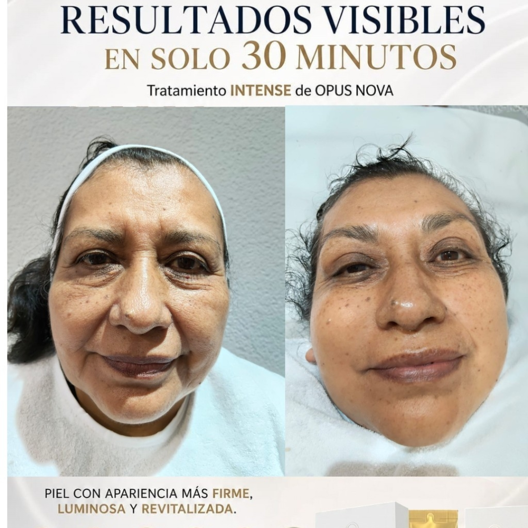 Resultado antes y después KALPA INTENSE — rostro visiblemente revitalizado