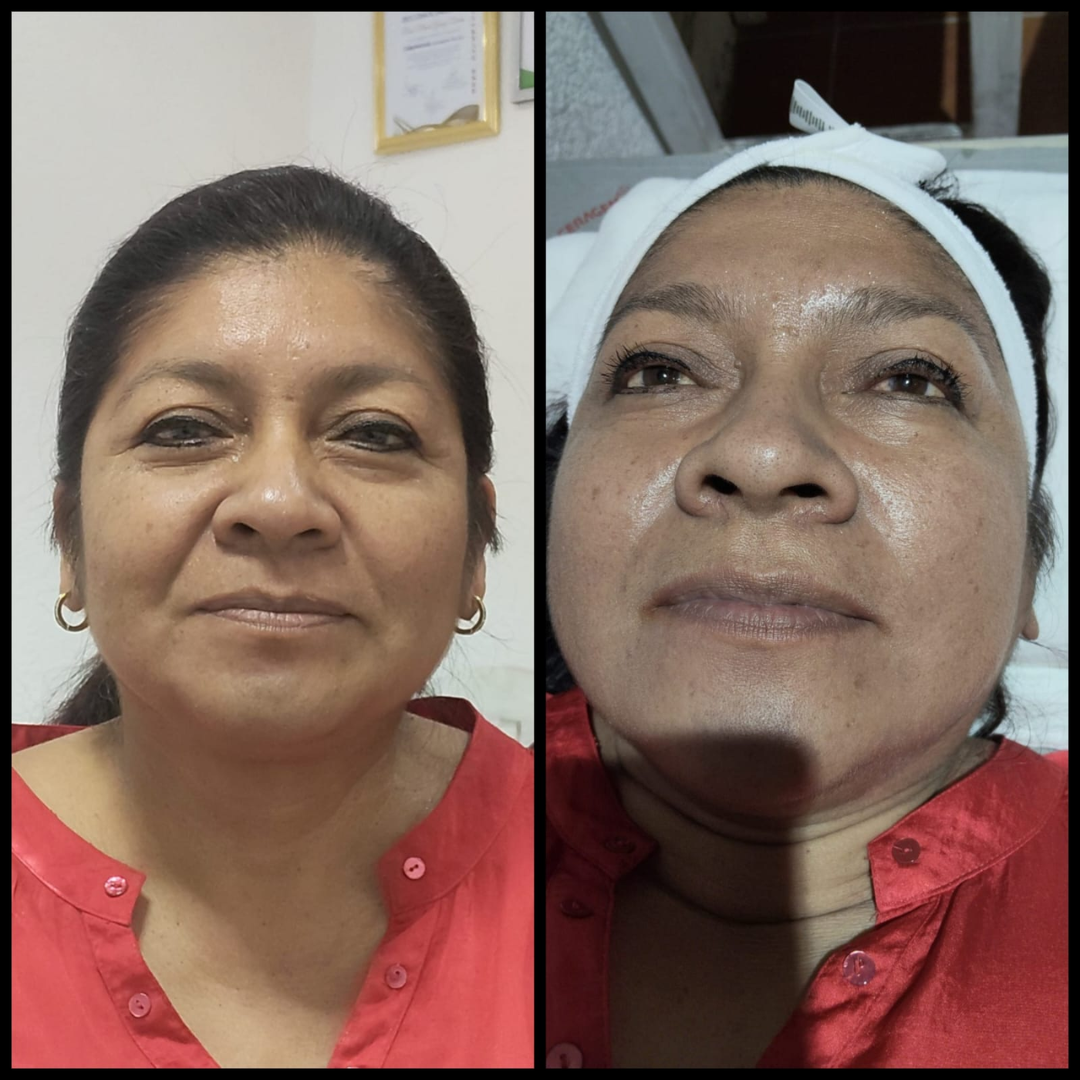 Testimonio real — efecto lifting inmediato con KALPA