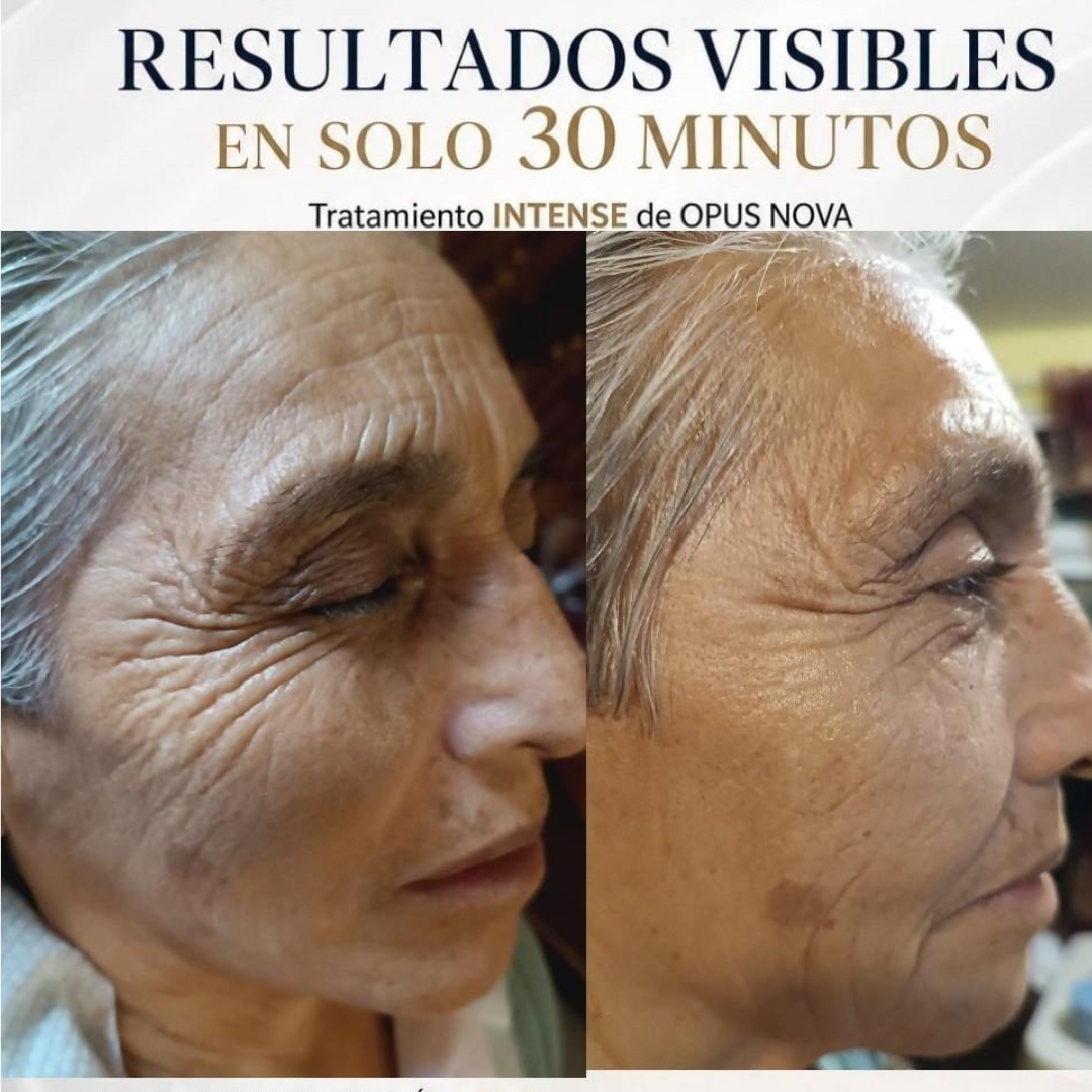Resultado antes y después KALPA INTENSE — piel más firme y luminosa